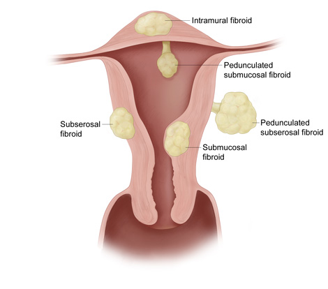 UTERINE FIBROIDS