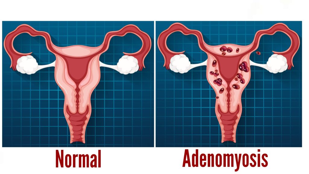 Adenomyosis1