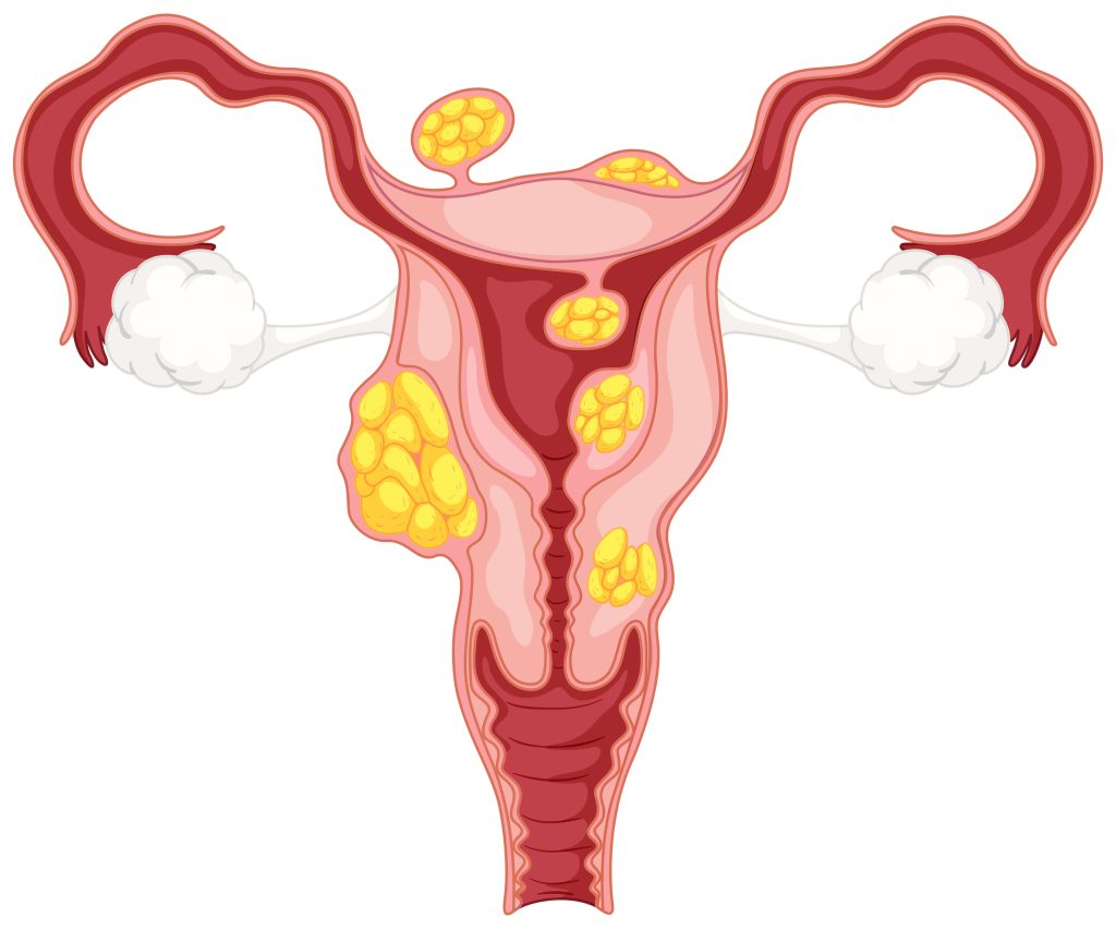 Endometriosis 1 compressed