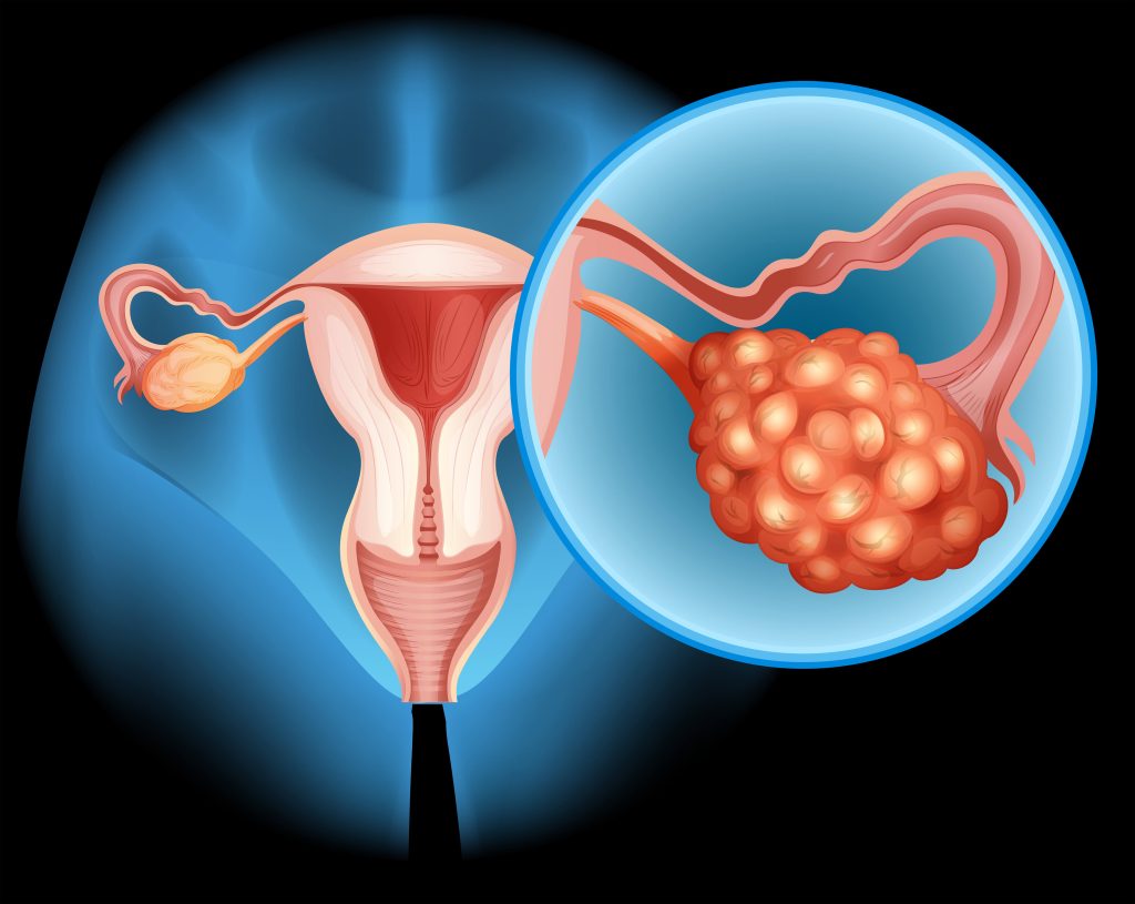 Ovarian Cyst compressed